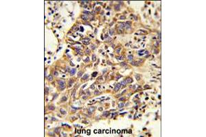 Formalin-fixed and paraffin-embedded human lung carcinoma reacted with CAT Antibody , which was peroxidase-conjugated to the secondary antibody, followed by DAB staining. (Catalase anticorps  (AA 152-180))