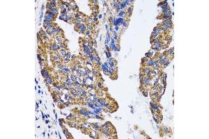 Immunohistochemistry of paraffin-embedded human gastric cancer using TP53 antibody.