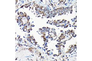 Immunohistochemistry of paraffin-embedded human lung cancer using USP5 Rabbit pAb (ABIN1683231, ABIN3018687, ABIN3018688 and ABIN6220542) at dilution of 1:100 (40x lens).