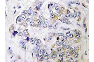 Immunohistochemistry (IHC) analyzes of PRIM1 antibody in paraffin-embedded human breast carcinoma tissue. (PRIM1 anticorps)