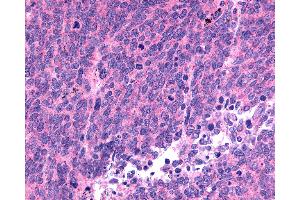 Anti-SSTR1 antibody IHC of human Lung, Small Cell Carcinoma. (SSTR1 anticorps  (C-Term))