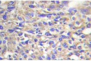 Immunohistochemistry (IHC) analyzes of Laminin beta-1 antibody in paraffin-embedded human liver carcinoma tissue. (Laminin beta 1 anticorps)