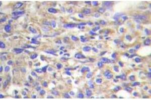 Immunohistochemistry (IHC) analyzes of Laminin beta-1 antibody in paraffin-embedded human liver carcinoma tissue. (Laminin beta 1 anticorps)