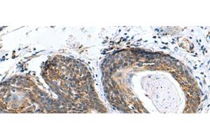 Immunohistochemistry of paraffin-embedded Human esophagus cancer tissue using AP1S3 Polyclonal Antibody at dilution of 1:70(x200)