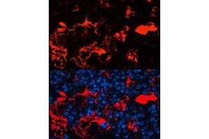 Immunofluorescence analysis of human liver cancer cells using Albumin antibody (ABIN3021924, ABIN3021925, ABIN3021926, ABIN1512560 and ABIN6217701) at dilution of 1:100. (Albumin anticorps)