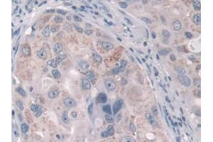 DAB staining on IHC-P; Samples: Human Breast cancer Tissue (FcRn anticorps  (AA 24-365))