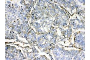 IHC testing of FFPE human lung cancer tissue with HBD antibody at 1ug/ml. (HBd anticorps)