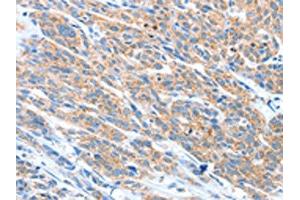 The image on the left is immunohistochemistry of paraffin-embedded Human esophagus cancer tissue using ABIN7128229(ADAM2 Antibody) at dilution 1/20, on the right is treated with fusion protein. (ADAM2 anticorps)