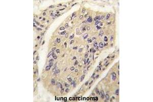 Formalin-fixed and paraffin-embedded human lung carcinoma tissue reacted with GHRH antibody (N-term) (ABIN392174 and ABIN2841887) , which was peroxidase-conjugated to the secondary antibody, followed by DAB staining. (GHRH anticorps  (N-Term))