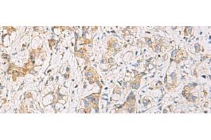 Immunohistochemistry of paraffin-embedded Human liver cancer tissue using FYCO1 Polyclonal Antibody at dilution of 1:110(x200) (FYCO1 anticorps)