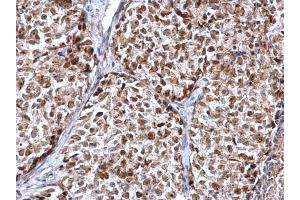 IHC-P Image FEN1 antibody detects FEN1 protein at nucleus on human breast carcinoma by immunohistochemical analysis. (FEN1 anticorps)