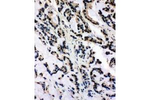 Anti-SNRPN antibody, IHC(P) IHC(P): Human Intestinal Cancer Tissue (SNRPN anticorps  (N-Term))