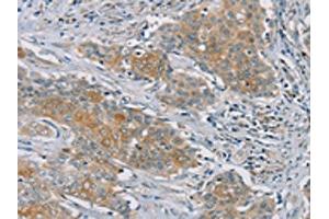 The image on the left is immunohistochemistry of paraffin-embedded Human ovarian cancer tissue using ABIN7192147(RASA2 Antibody) at dilution 1/45, on the right is treated with synthetic peptide. (RASA2 anticorps)