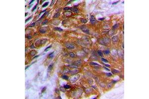 Immunohistochemical analysis of PAK1 (pT212) staining in human prostate cancer formalin fixed paraffin embedded tissue section. (PAK1 anticorps  (pSer212))