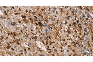 Immunohistochemistry of paraffin-embedded Human liver cancer tissue using TSPEAR Polyclonal Antibody at dilution 1:50