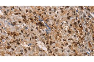 Immunohistochemistry of paraffin-embedded Human liver cancer tissue using TSPEAR Polyclonal Antibody at dilution 1:50 (TSPEAR anticorps)