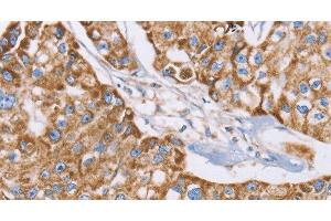 Immunohistochemistry of paraffin-embedded Human breast cancer tissue using GUCY1A3 Polyclonal Antibody at dilution 1:40 (GUCY1A1 anticorps)