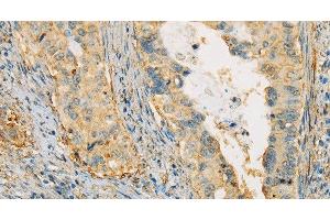 Immunohistochemistry of paraffin-embedded Human cervical cancer tissue using APOA4 Polyclonal Antibody at dilution 1:30 (APOA4 anticorps)