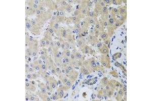 Immunohistochemistry of paraffin-embedded human liver injury using MB21D1 antibody. (C6orf150 anticorps)