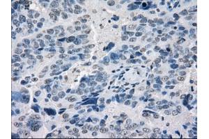 Immunohistochemical staining of paraffin-embedded Adenocarcinoma of breast tissue using anti-POR mouse monoclonal antibody. (POR anticorps)