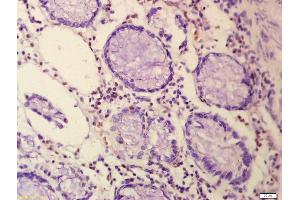 Formalin-fixed and paraffin embedded human colon carcinoma labeled with Anti-n-Myc Polyclonal Antibody, Unconjugated (ABIN760676) at 1:200 followed by conjugation to the secondary antibody and DAB staining