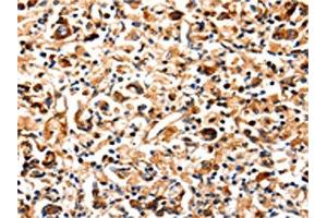 The image on the left is immunohistochemistry of paraffin-embedded Human gastric cancer tissue using ABIN7129022(COX8A Antibody) at dilution 1/12, on the right is treated with fusion protein.