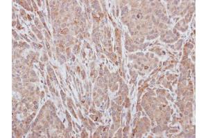 IHC-P Image Immunohistochemical analysis of paraffin-embedded A549 xenograft, using ADAMTS5, antibody at 1:100 dilution.