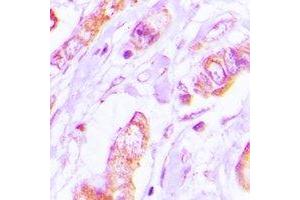 Immunohistochemical analysis of Tropomyosin 2 staining in human lung cancer formalin fixed paraffin embedded tissue section. (TPM2 anticorps)