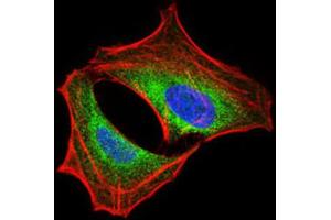 Immunohistochemical analysis of paraffin-embedded cervical cancer tissues using PIK3R1 antibody with DAB staining.