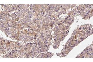 ABIN6276687 at 1/100 staining Human liver cancer tissue by IHC-P. (FSHR anticorps  (Internal Region))