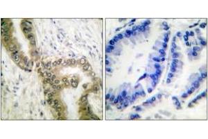 Immunohistochemistry analysis of paraffin-embedded human lung carcinoma tissue, using p53 (Acetyl-Lys386) Antibody. (p53 anticorps  (acLys386))