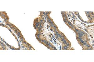 Immunohistochemistry of paraffin-embedded Human thyroid cancer tissue using TMPRSS13 Polyclonal Antibody at dilution 1:40 (TMPRSS13 anticorps)
