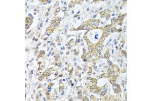 Immunohistochemistry of paraffin-embedded human gastric cancer using TICAM1 antibody at dilution of 1:100 (40x lens).