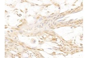 Detection of GAL3 in Human Ovarian cancer Tissue using Polyclonal Antibody to Galectin 3 (GAL3)