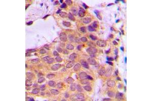 Immunohistochemical analysis of PKC zeta staining in human breast cancer formalin fixed paraffin embedded tissue section.