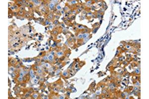 The image on the left is immunohistochemistry of paraffin-embedded Human breast cancer tissue using ABIN7190498(DPYSL5 Antibody) at dilution 1/10, on the right is treated with synthetic peptide. (DPYSL5 anticorps)