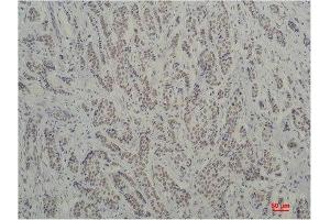 Immunohistochemistry (IHC) analysis of paraffin-embedded Human Breast Carcinoma using TBP/TATA Binding Protein Mouse Monoclonal Antibody diluted at 1:200. (TBP anticorps)