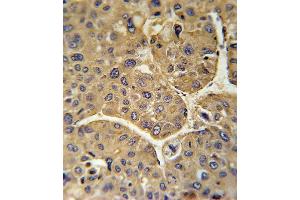 CFHR5 Antibody (Center) (ABIN651876 and ABIN2840434) immunohistochemistry analysis in formalin fixed and paraffin embedded human hepatocarcinoma followed by peroxidase conjugation of the secondary antibody and DAB staining.