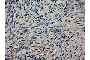 Immunohistochemical staining of paraffin-embedded Adenocarcinoma of colon tissue using anti-LDHAmouse monoclonal antibody. (Lactate Dehydrogenase A anticorps)