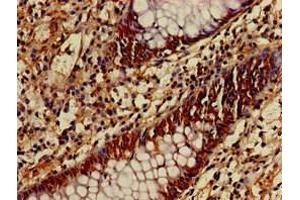 Immunohistochemistry of paraffin-embedded human colon cancer using ABIN7149021 at dilution of 1:100 (ATG4B anticorps  (AA 350-400))