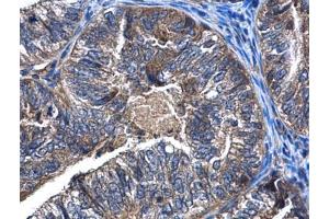 IHC-P Image CaMKK beta antibody detects CaMKK beta protein at cytoplasm in human endometrial cancer by immunohistochemical analysis. (CAMKK2 anticorps  (N-Term))