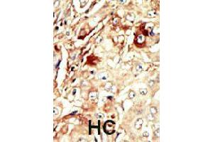 Formalin-fixed and paraffin-embedded human hepatocellular carcinoma tissue reacted with WEE1 polyclonal antibody  , which was peroxidase-conjugated to the secondary antibody, followed by AEC staining. (WEE1 anticorps  (Internal Region))