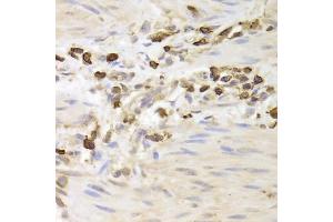 Immunohistochemistry of paraffin-embedded human gastric cancer using LSP1 Antibody. (LSP1 anticorps)