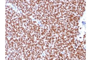 Formalin-fixed, paraffin-embedded human Ewing's Sarcoma stained with NKX2. (Recombinant Nkx2-2 anticorps)