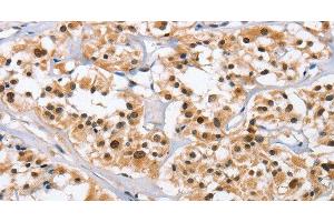 Immunohistochemistry of paraffin-embedded Human thyroid cancer tissue using NCAPD3 Polyclonal Antibody at dilution 1:50 (NCAPD3 anticorps)