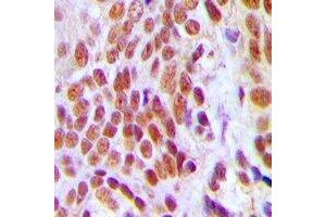 Immunohistochemical analysis of HMGB2 staining in human breast cancer formalin fixed paraffin embedded tissue section. (HMGB2 anticorps)