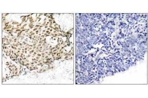 Immunohistochemical analysis of paraffin-embedded human breast carcinoma tissue using p95/NBS1 (Ab-343) antibody (E021058). (Nibrin anticorps)