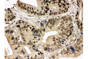 Anti- SMC3 Picoband antibody, IHC(P) IHC(P): Human Intestinal Cancer Tissue (SMC3 anticorps  (C-Term))