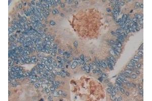 Detection of KLK10 in Human Colorectal cancer Tissue using Polyclonal Antibody to Kallikrein 10 (KLK10)