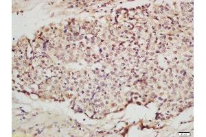 Formalin-fixed and paraffin embedded human layngocarcinoma labeled with Anti-IRF2 Polyclonal Antibody, Unconjugated  at 1:200 followed by conjugation to the secondary antibody and DAB staining.